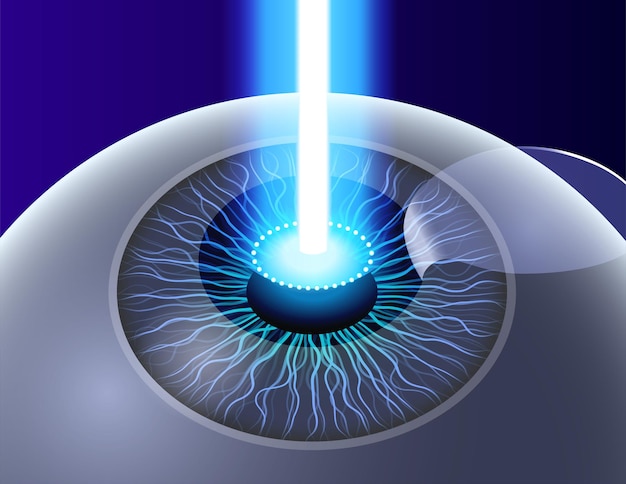 lasik eye surgery