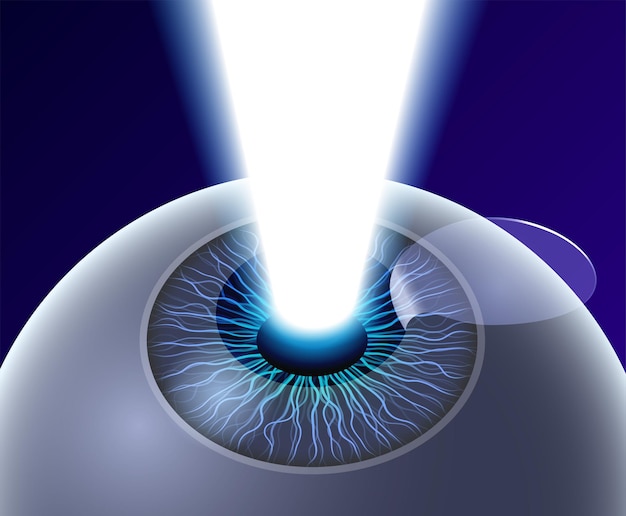 lasik eye surgery