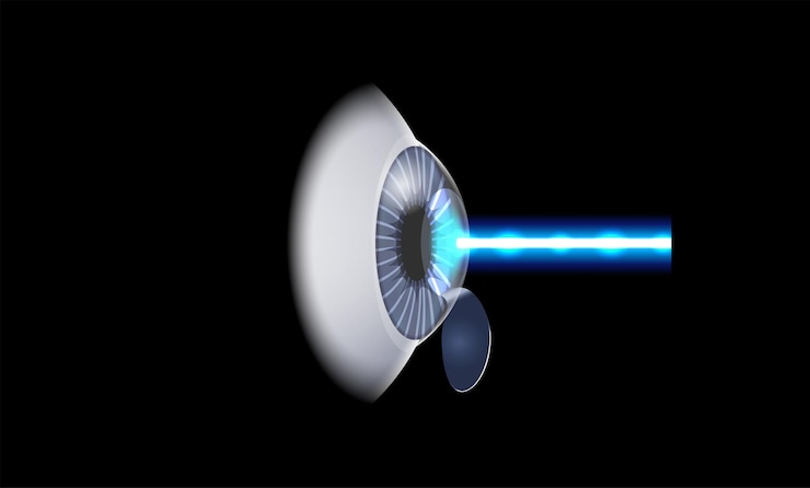 Vector lasik eye surgery