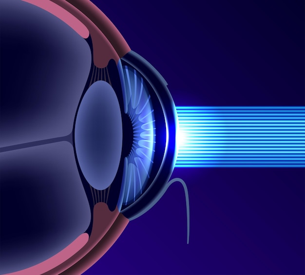 lasik eye surgery