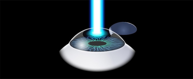 lasik eye surgery