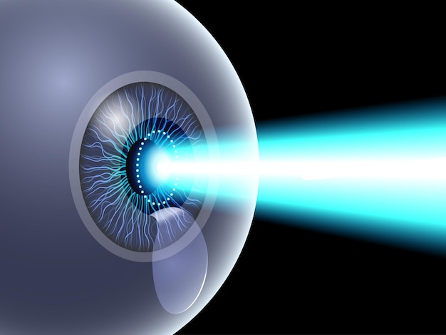 lasik eye surgery