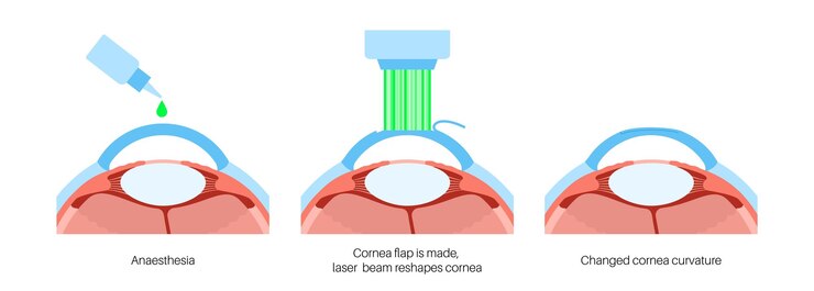 LASIK oogchirurgie