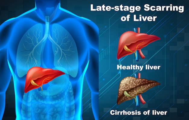 Vector late-stage scarring of liver