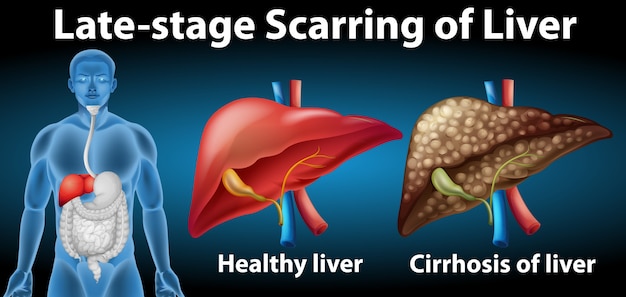 Late-stage scarring of liver