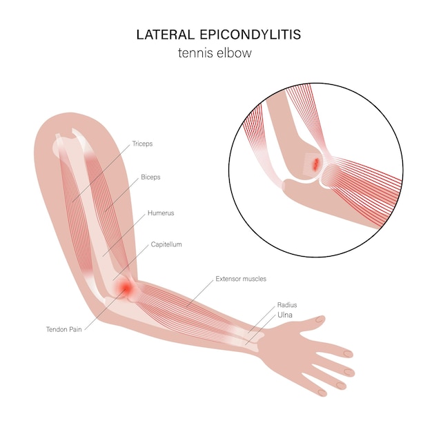 Vector lateral epicondylitis tennis elbow