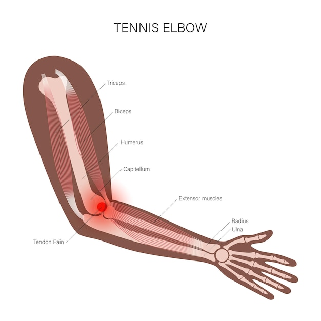 Epicondilite laterale del gomito del tennista