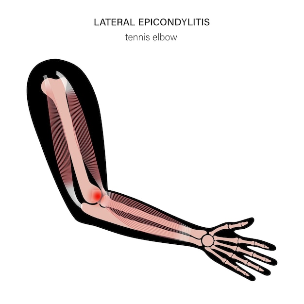 Lateral epicondylitis tennis elbow