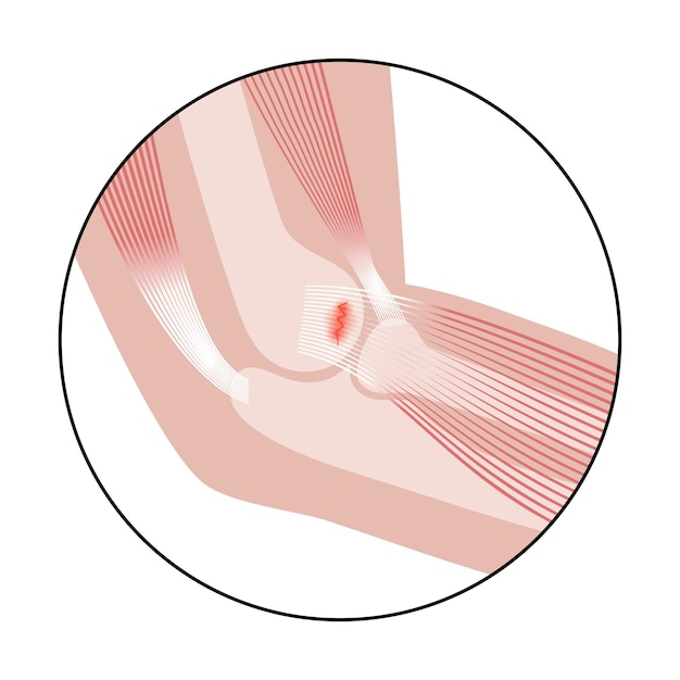 Vector lateral epicondylitis tennis elbow