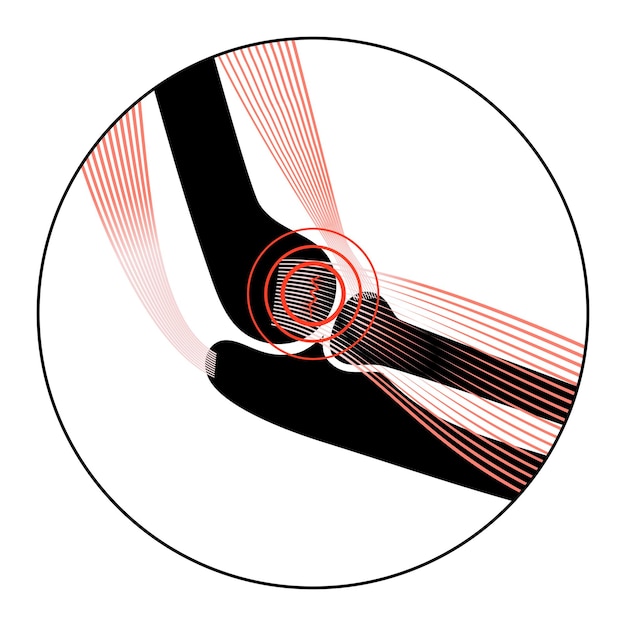 Vector lateral epicondylitis tennis elbow