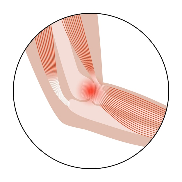 Vector lateral epicondylitis tennis elbow