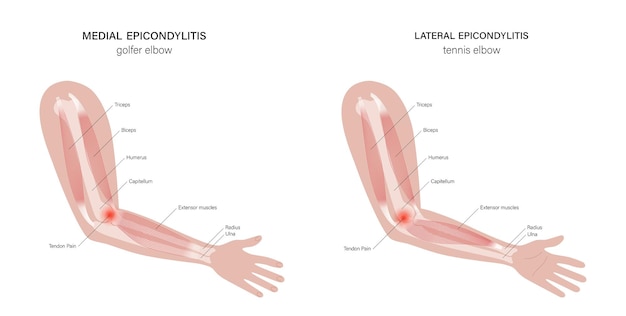 Vector lateral medial epicondylitis