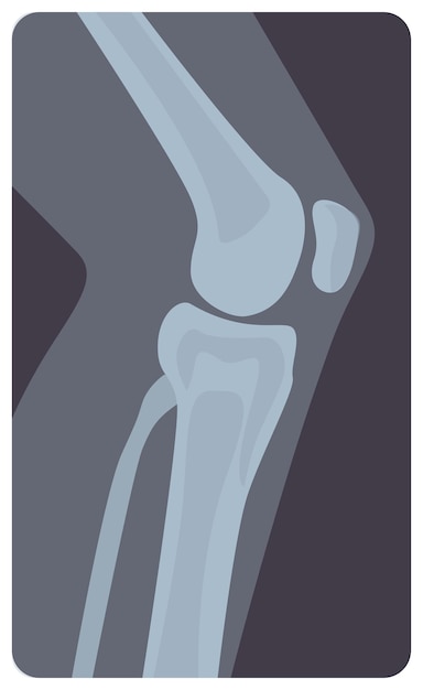 人間の膝関節の側面x線写真