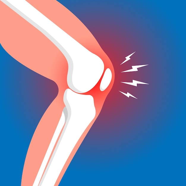 Leg bones and knee joint cartilage inflammation on blue background Human skeleton anatomy