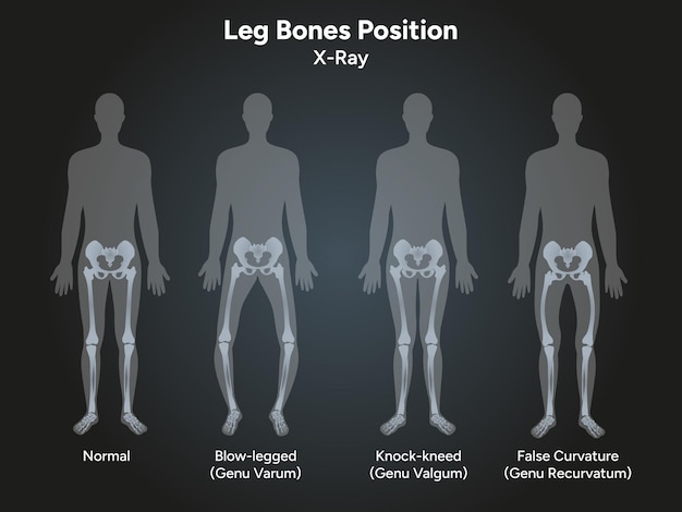 Vector leg bones position blowlegged knockkneed face curvature in xray