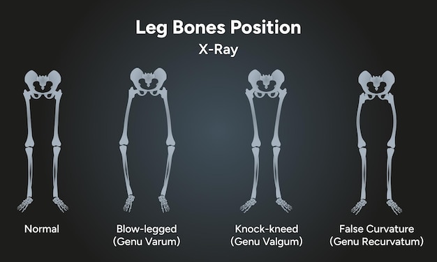 Vector leg bones position blowlegged knockkneed in xray