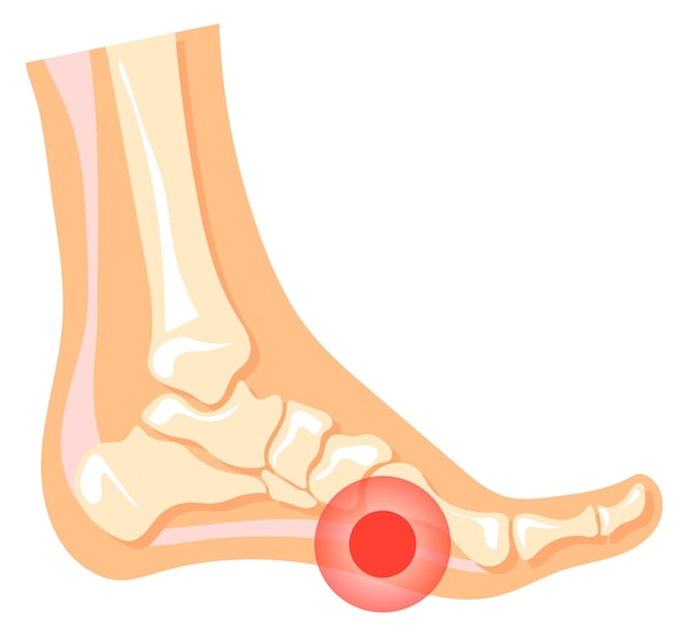 足の痛み 人間の足の赤い斑点 医療イラスト