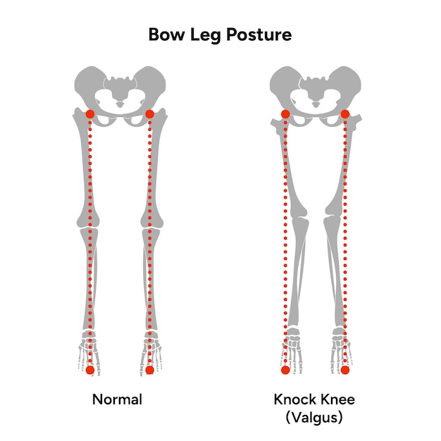 Legpositie Blowlegged botten