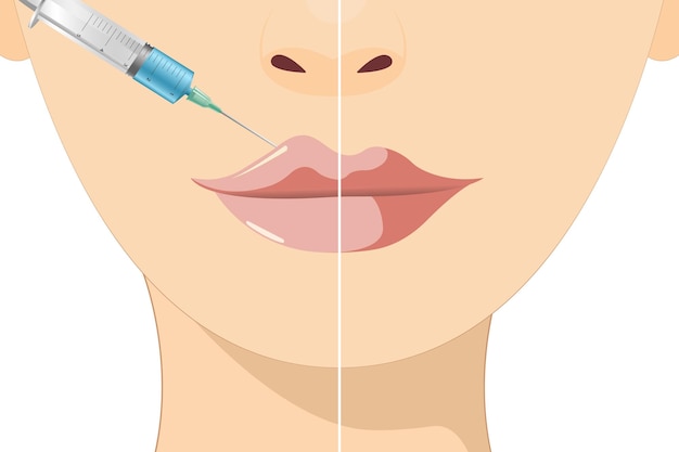 Vector lip augmentation and correction lip filler injections hyaluronic acid cosmetology procedure in a