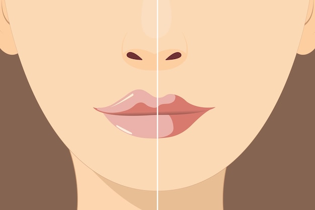 Vector lip augmentation and correction lip filler injections hyaluronic acid cosmetology procedure in a