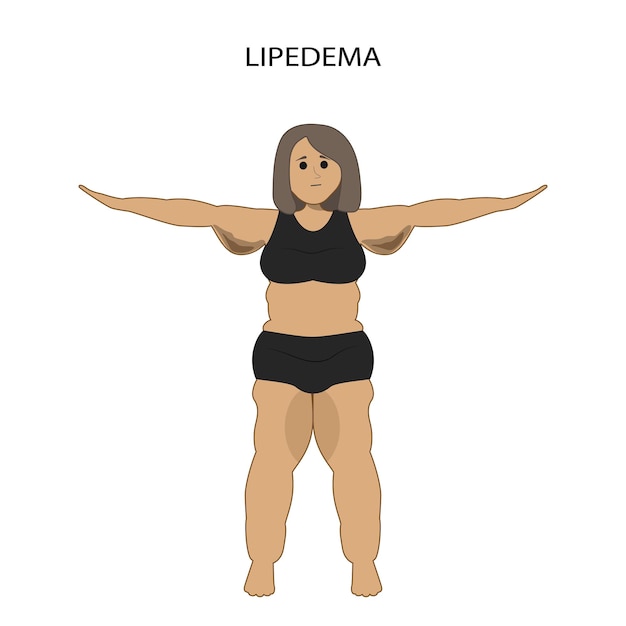 ベクトル 脂肪浮腫のコンセプト デザイン - 脂肪浮腫疾患を持つ女性