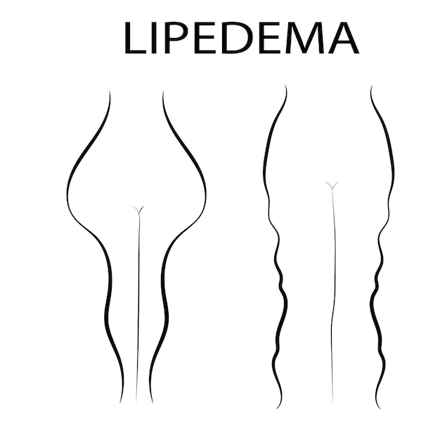 Lipedema Concept Outline Design - Vector Illustration