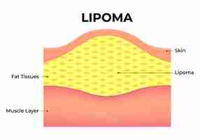 Vector lipoma vector illustration