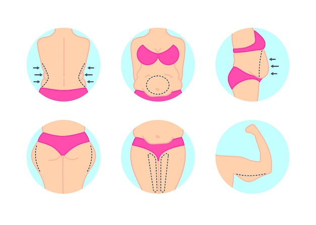 Liposuction plastic surgery