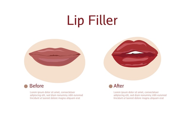 Vector lips filler hand drawn flat illustration