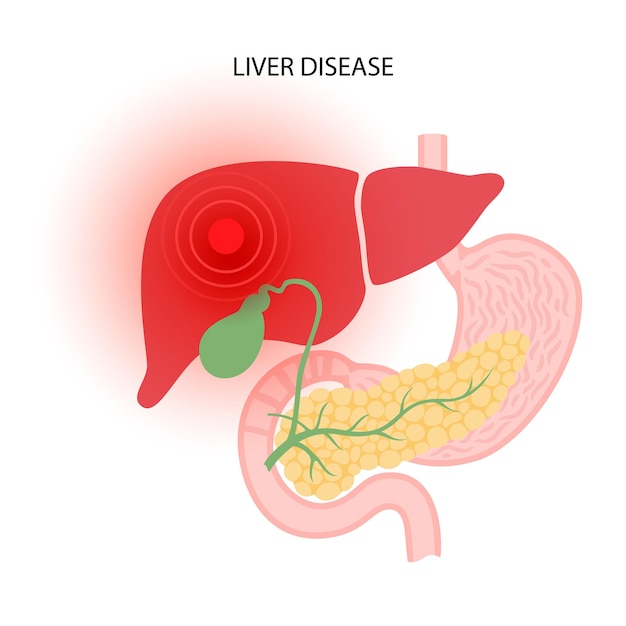 Vector liver disease concept