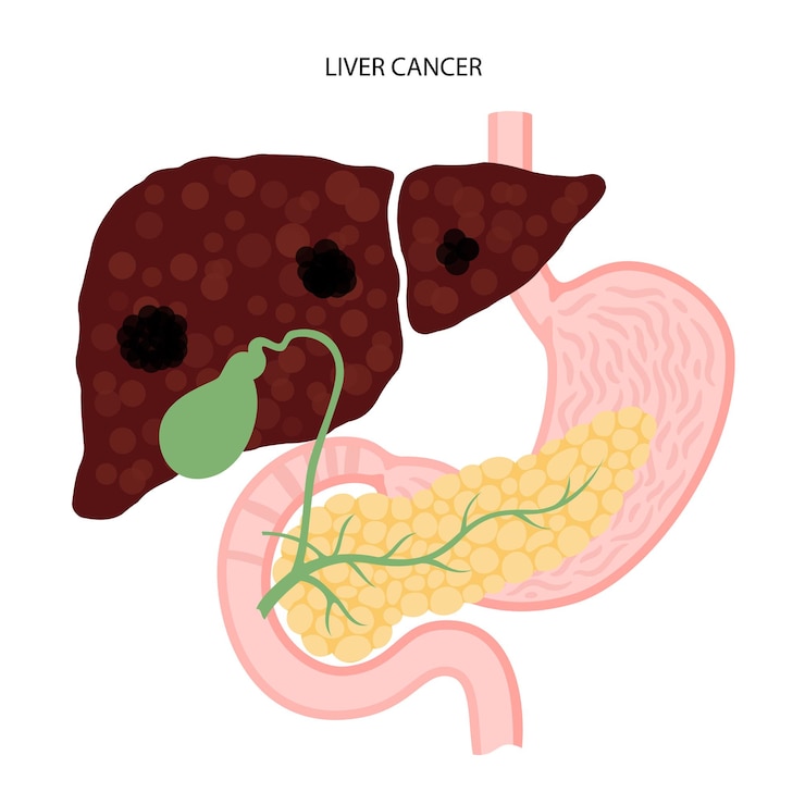 Vector liver disease concept
