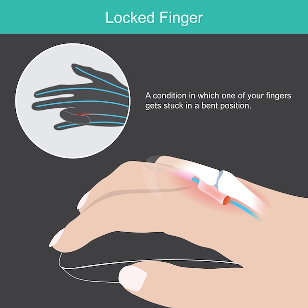 잠긴 손가락. 손가락이 구부러진 위치에 끼인 것을 보여주는 손 샘플.