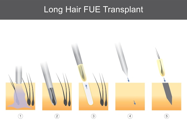 Vettore illustrazione di trapianto fue di capelli lunghi per uso medico che mostra le fasi tecniche del trapianto di capelli