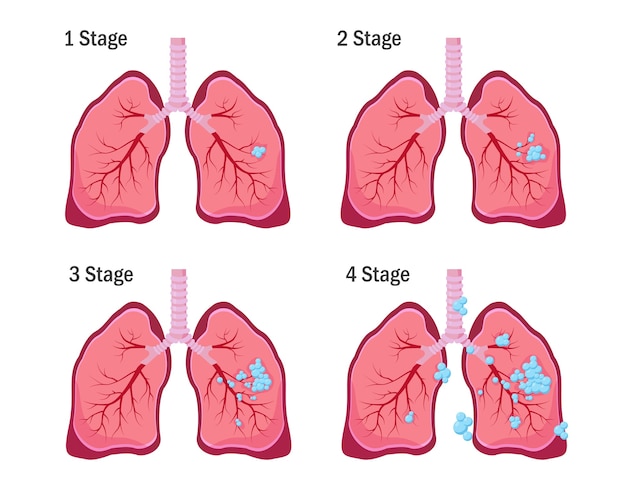 Concetto di cancro ai polmoni. quattro fasi della malattia del cancro del polmone.