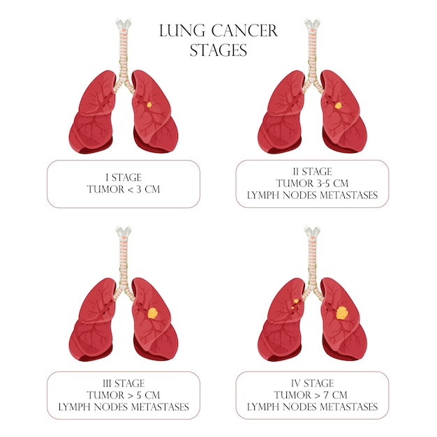 Lung cancer stages concept diseases human internal organs cartoon style vector illustration