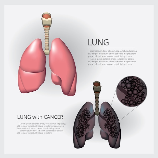 Lung with detail and lung cancer  illustration