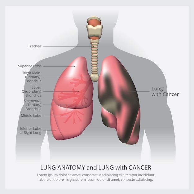 Lung with detail and lung cancer