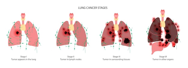 Vector lungs cancer disease