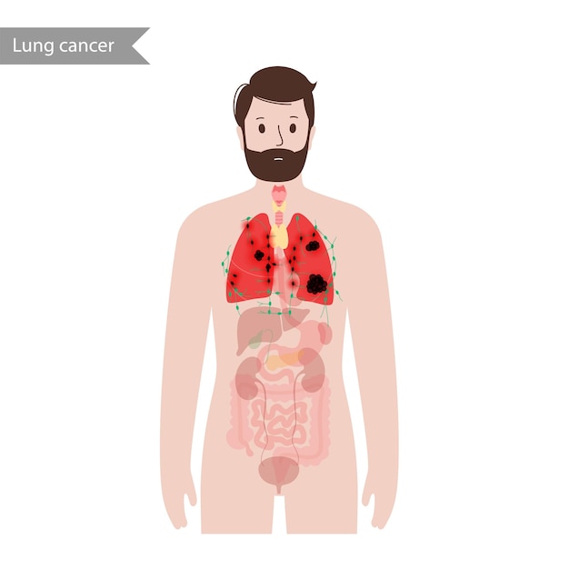 Lungs cancer disease