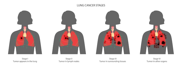 Vettore stadi del cancro ai polmoni