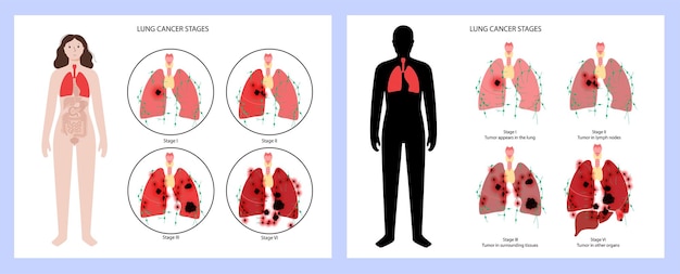 Lungs cancer stages