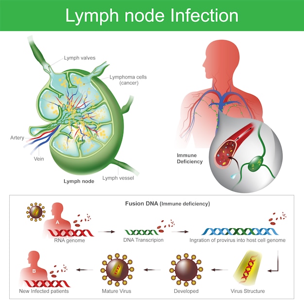 Lymfeklierinfectie. de lymfeklieren zijn geïnfecteerd. falen van het immuunsysteem, het lichaam vatbaarder
