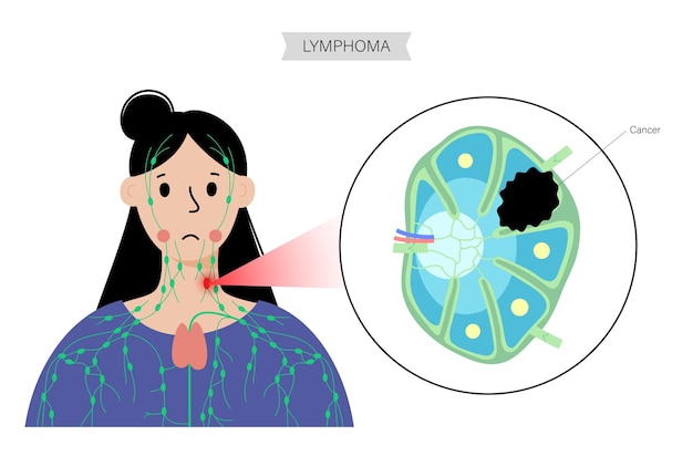 Vector lymfoom kanker concept