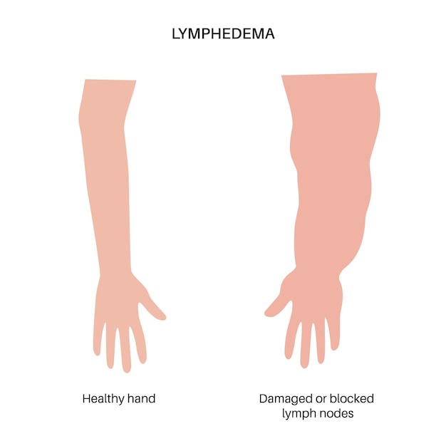 Vector lymphedema of arm