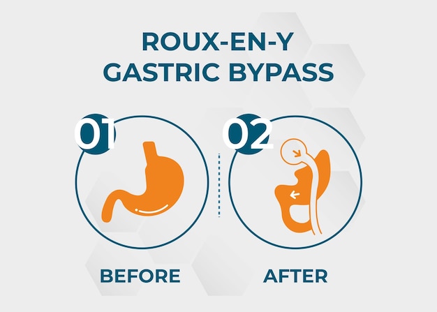 Vector maagbypass rny gewichtsverlies chirurgie vector illustratie pictogram rouxeny