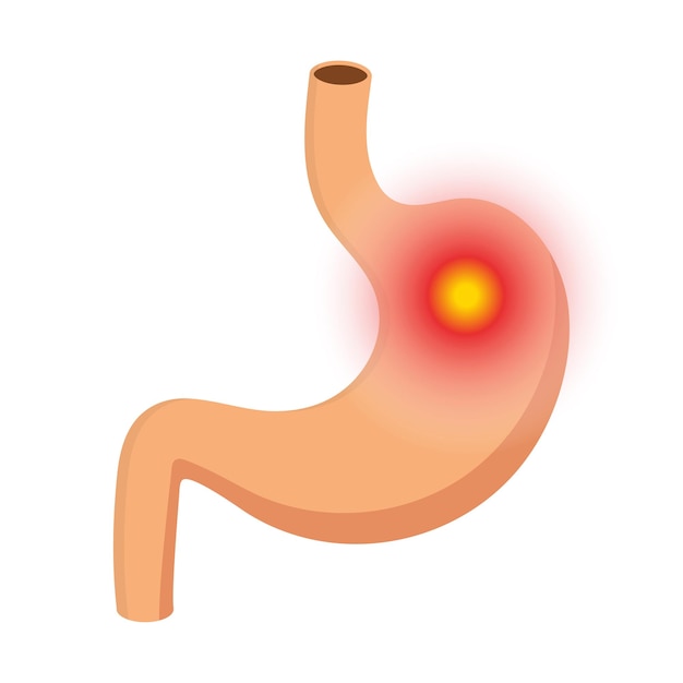 Maagpijn illustratie Rode pijn cirkel als symbool van pijn in een maag Indigestie vector