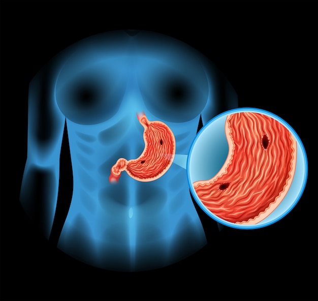 Vector maagzweer diagram in mens