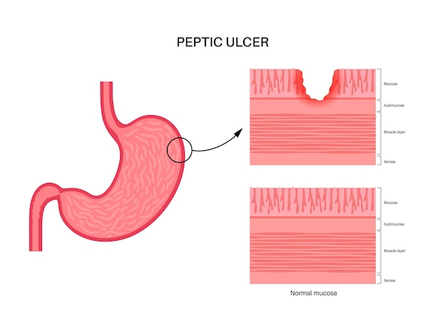 Maagzweer Ziekte Pijnlijk op de wand van de maag Buikpijn in het menselijk lichaam Infectie in het spijsverteringskanaal Gastro-enterologie concept Maagproblemen anatomische platte vectorillustratie