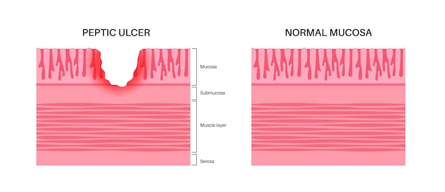 Maagzweer ziekte pijnlijk op de wand van de maag buikpijn in het menselijk lichaam infectie in het spijsverteringskanaal gastro-enterologie concept maagproblemen anatomische platte vectorillustratie