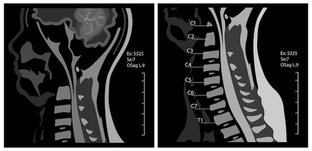 자궁 경부를 보여주는 시상 투영에서 자궁 경부의 자기 공명 영상 또는 MRI